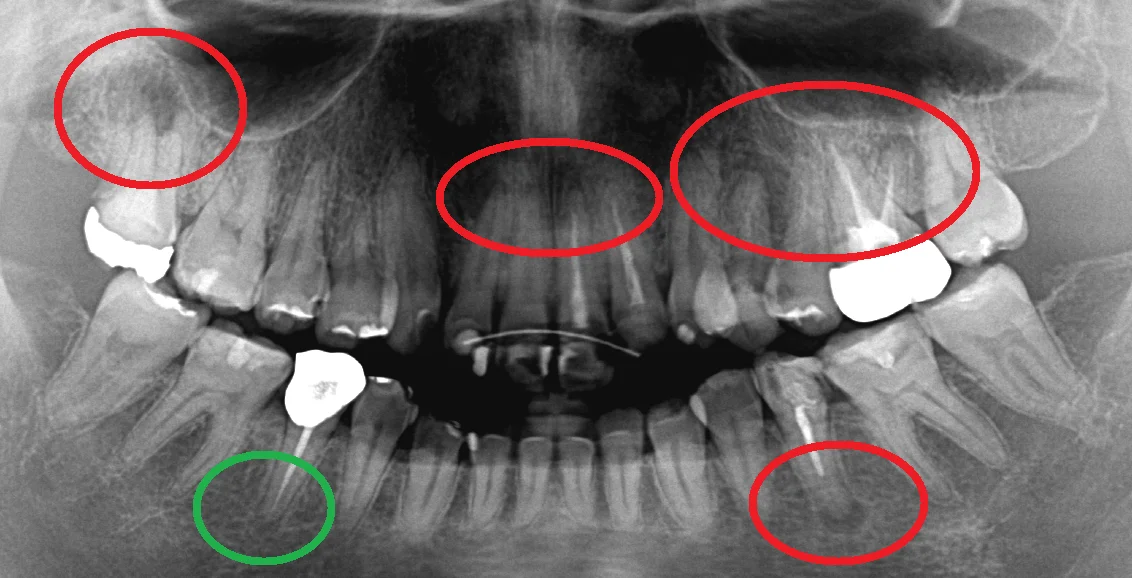 根管治療の成功率について｜坂寄歯科医院（取手市藤代）