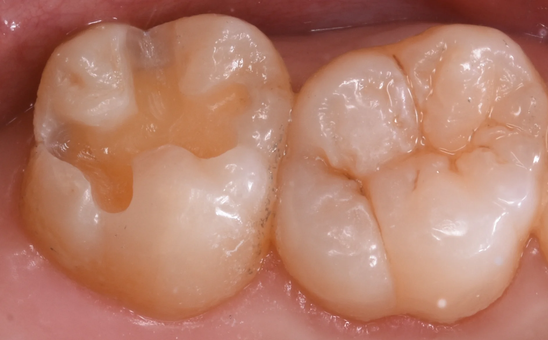 上の奥歯を金属から白い詰め物に。｜坂寄歯科医院（取手市藤代） - 画像2