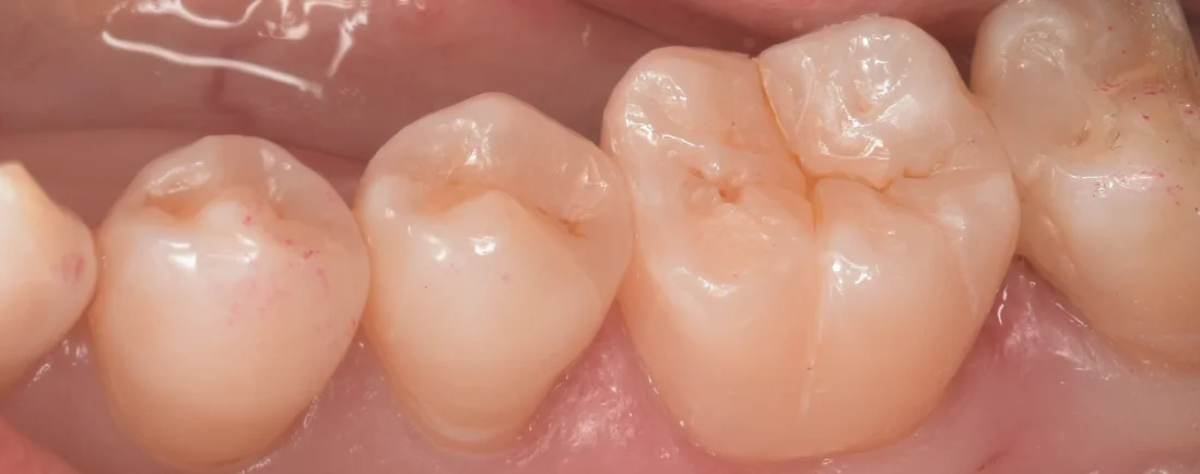 三鷹より来院された方|坂寄歯科医院(取手市藤代) - 画像8