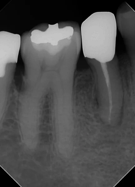 閉鎖根管の治療には根気が必要|坂寄歯科医院(取手市藤代) - 画像4