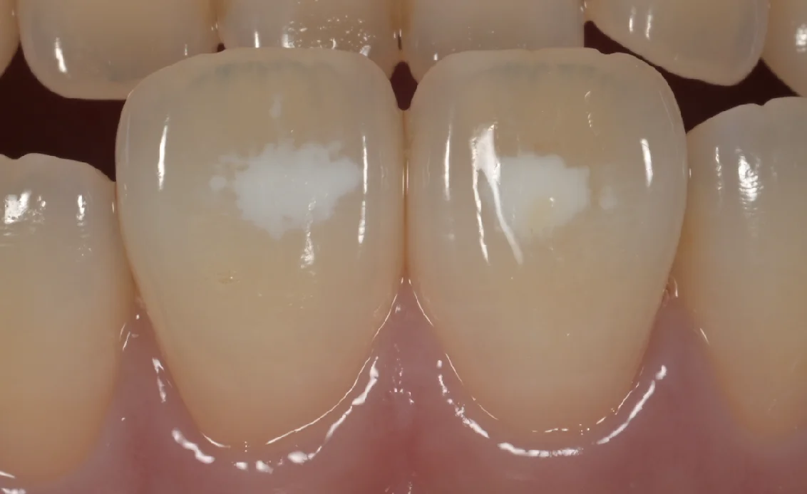 ICON治療。|坂寄歯科医院(取手市藤代)