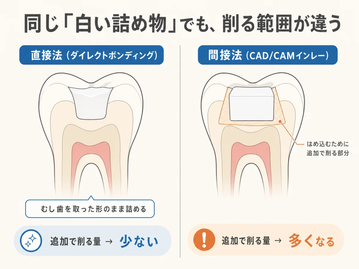 白い詰め物の入れ方を2つ並べて比較したインフォグラフィック。左が直接法（ダイレクトボンディング＝むし歯を取った形のまま直接レジンを詰めるため追加の削除が不要）、右が間接法（CAD/CAMインレー＝外で作ったかたまりをはめ込むため、穴の壁を入り口に向かって広げる追加削除が必要）であることを断面図で示した図｜取手市藤代の坂寄歯科医院