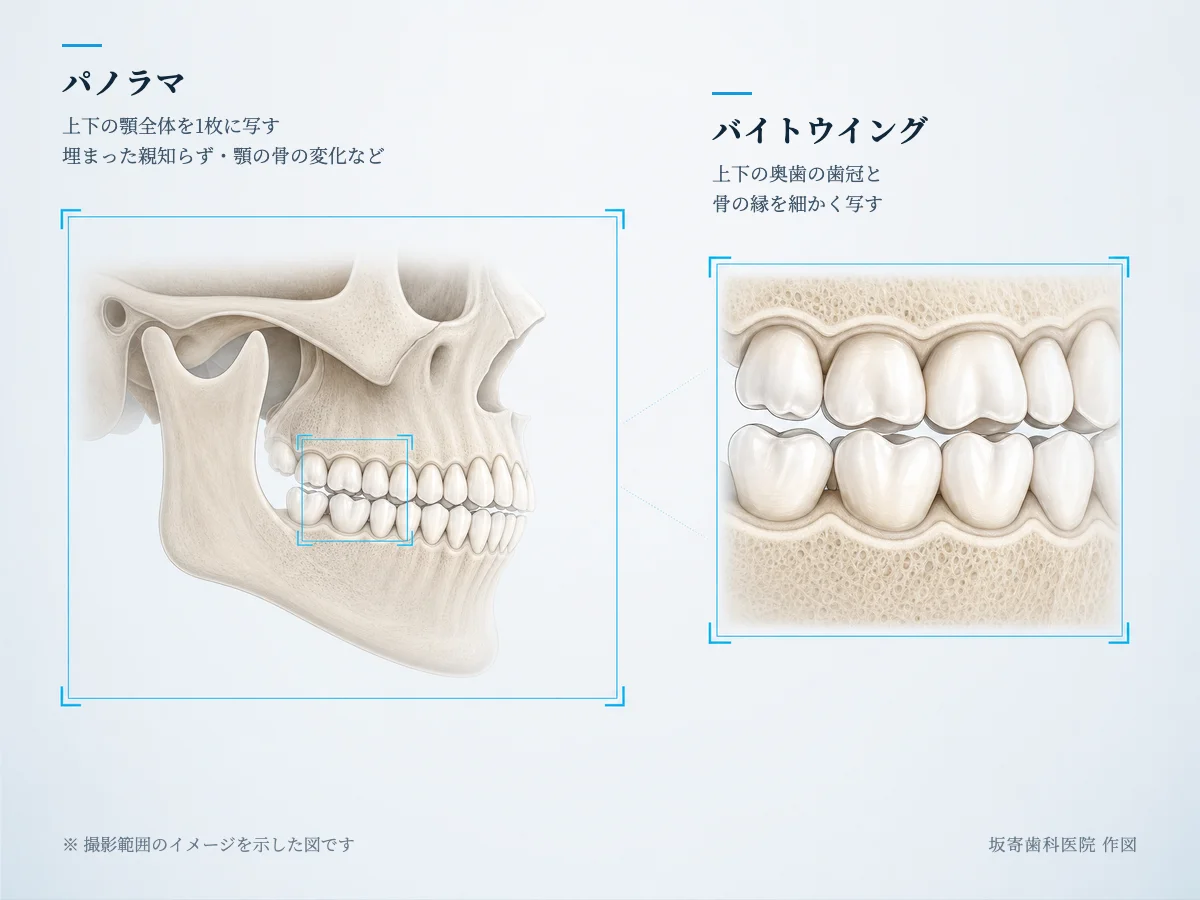 歯科のパノラマとバイトウイングの撮影範囲の違いを比較したインフォグラフィック。左は上下の顎全体を1枚に写すパノラマ、右は上下の奥歯の歯冠と骨の縁だけを細かく写すバイトウイングの範囲を、それぞれ枠で示した図｜取手市藤代の坂寄歯科医院