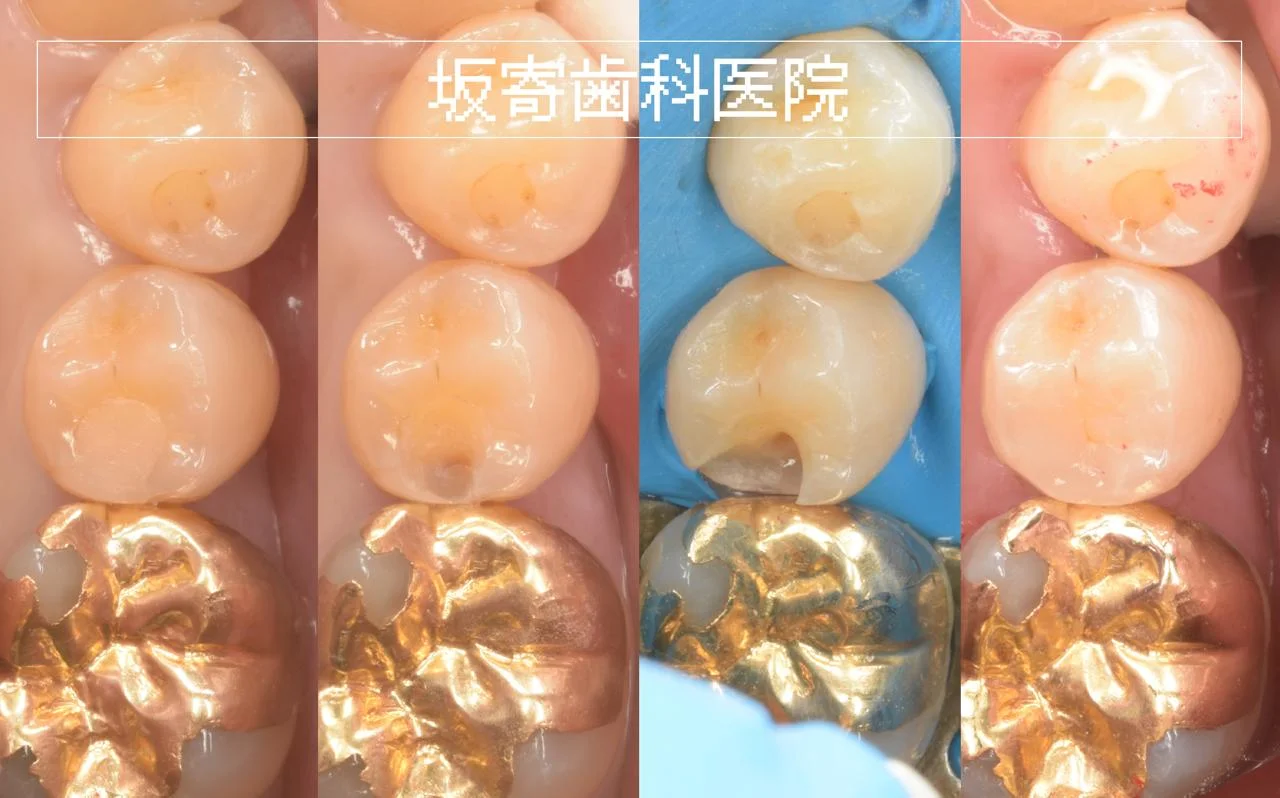 CRの下に広がっていた二次う蝕をダイレクトボンディングで修復｜左下5番 遠心2級窩洞 再治療症例