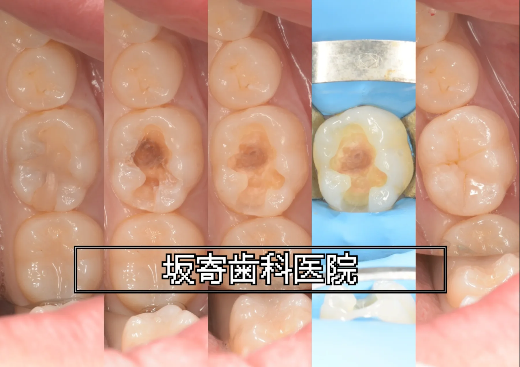 左下6番の詰め物の下の二次う蝕をダイレクトボンディングで再修復した症例(術前・旧修復物除去後のう蝕・う蝕除去後の窩洞・ラバーダム防湿・術後)の口腔内写真コラージュ|坂寄歯科医院