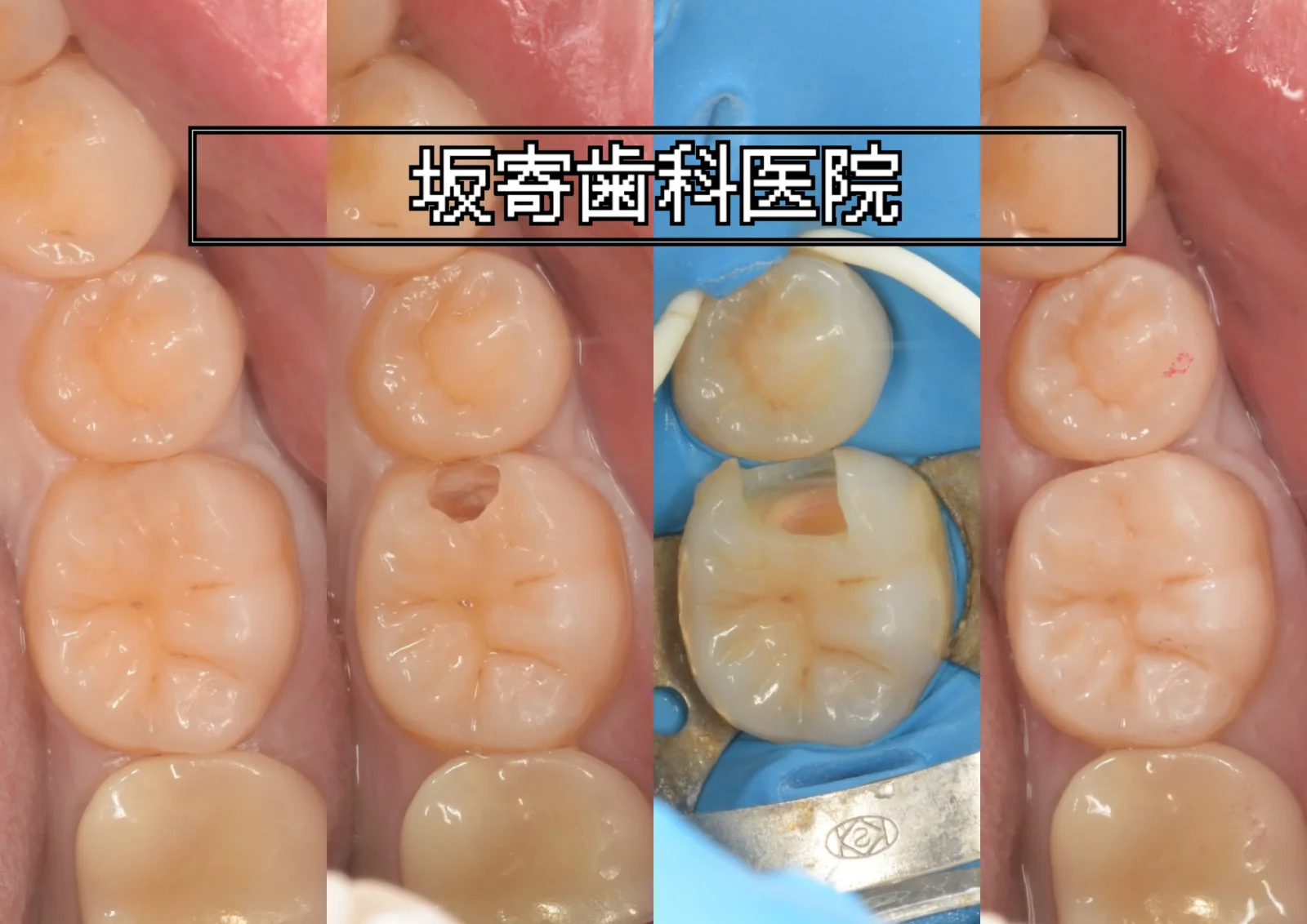 左下6番・詰め物の下で広がっていたむし歯を1回でダイレクトボンディング修復