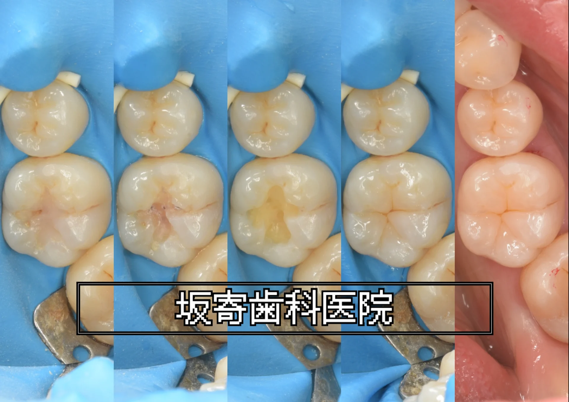 昔の保険治療部位を最小限の削合で再修復