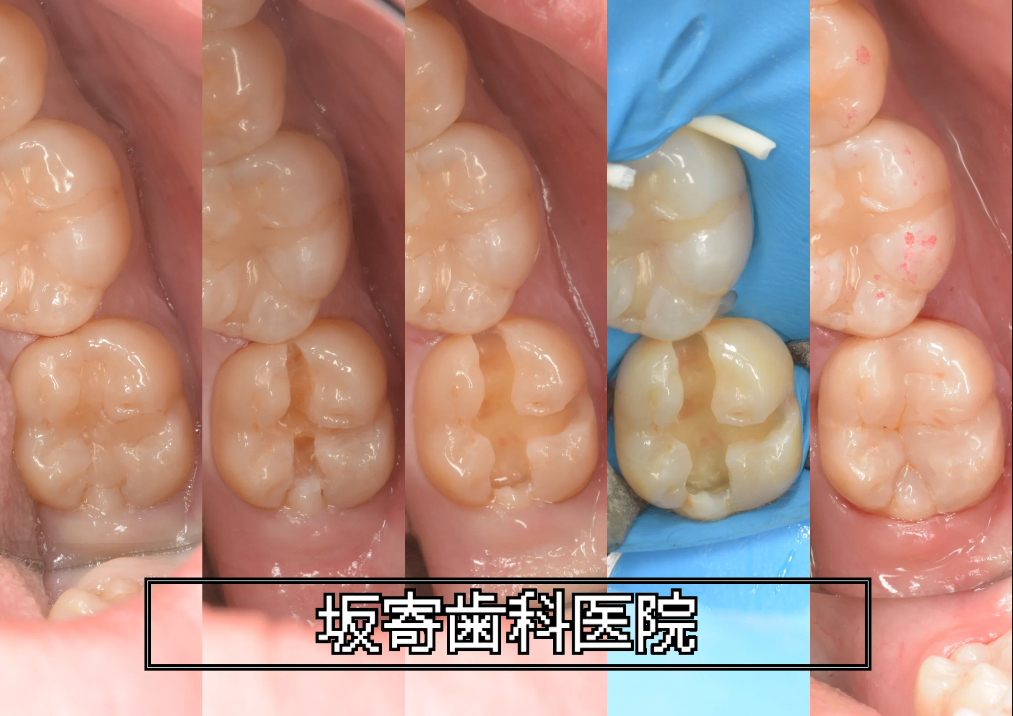 左下7番(下顎左第二大臼歯)MO窩洞のむし歯をダイレクトボンディングで修復した症例(術前・う蝕明示・う蝕除去・ラバーダム防湿後・術後)の写真コラージュ|坂寄歯科医院