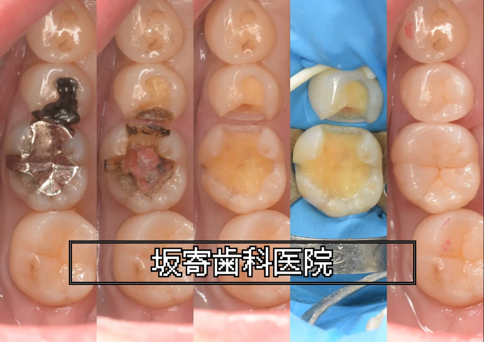 右下5番(下顎右第二小臼歯)と右下6番(下顎右第一大臼歯)の銀の詰め物をダイレクトボンディングにやり替えた症例(術前・詰め物の除去後・むし歯の除去後・ラバーダム防湿後・術後)の口腔内写真コラージュ|坂寄歯科医院