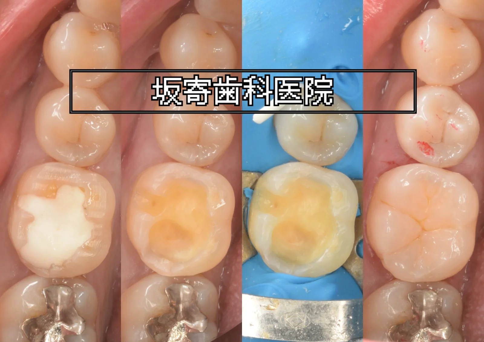 前医で咬合面を大きく削合され5咬頭を失った右下6番(下顎右第一大臼歯)をダイレクトボンディングで再建した症例(術前・仮封除去・ラバーダム防湿後・術後)の写真コラージュ|坂寄歯科医院