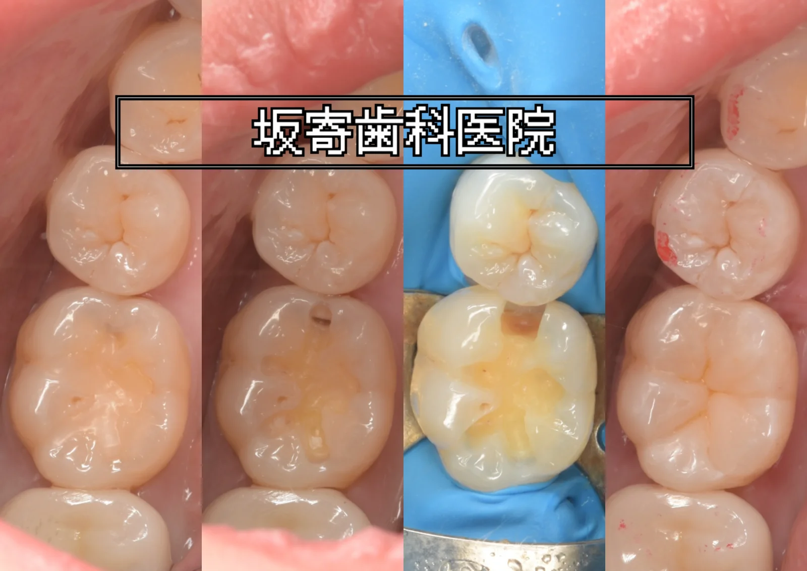 フロスが引っかかる右下6番のむし歯をダイレクトボンディングで修復