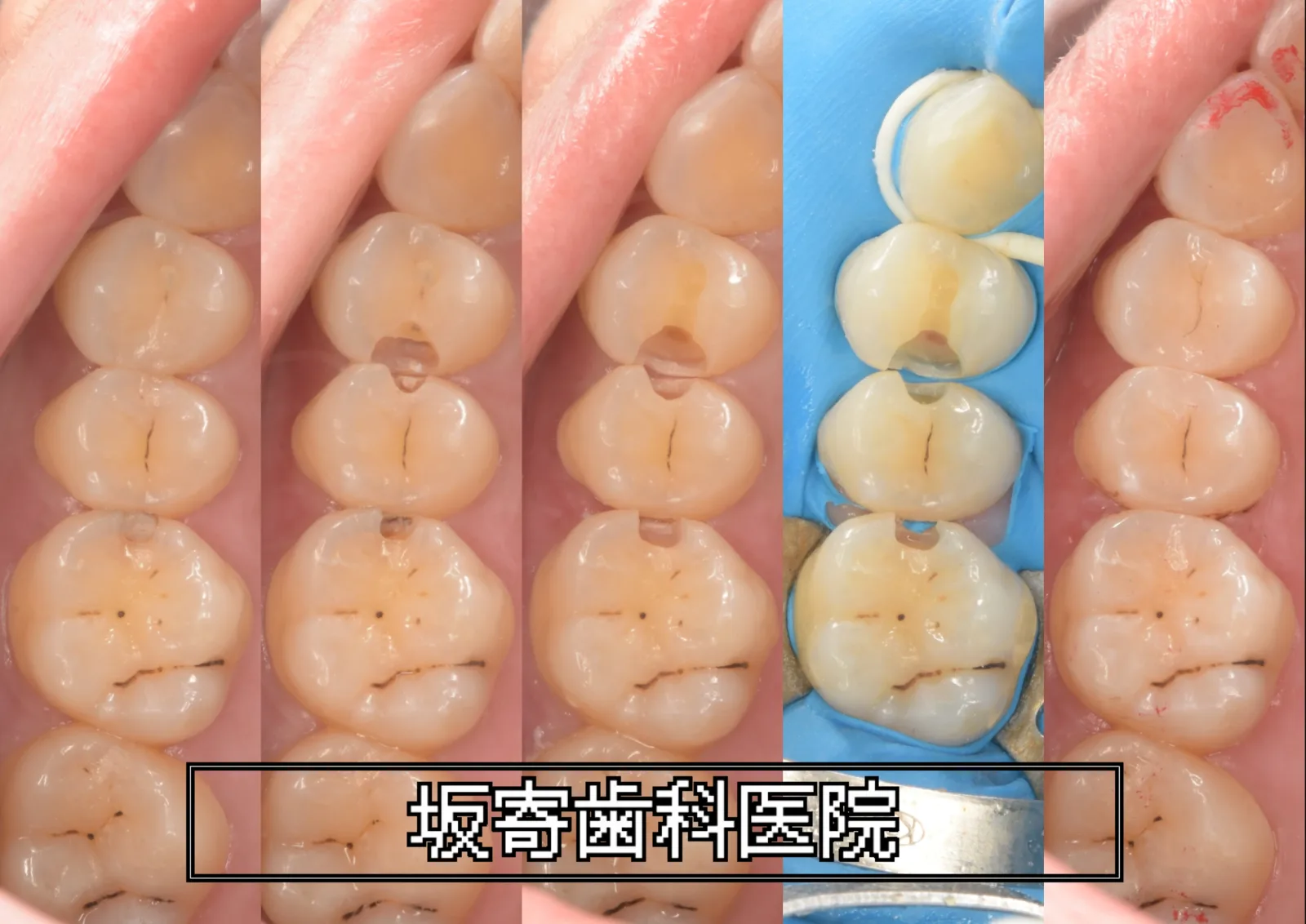 歯質を温存しながら左上の臼歯3本をダイレクトボンディングで修復