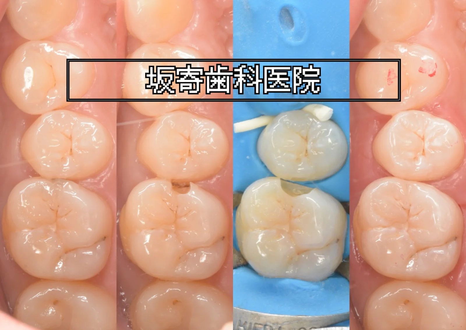 左上6番(上顎左第一大臼歯)の古い詰め物の下のむし歯と左上5番(上顎左第二小臼歯)をダイレクトボンディングで修復した症例(術前・古い詰め物の除去後・ラバーダム防湿後・術後)の口腔内写真コラージュ|坂寄歯科医院