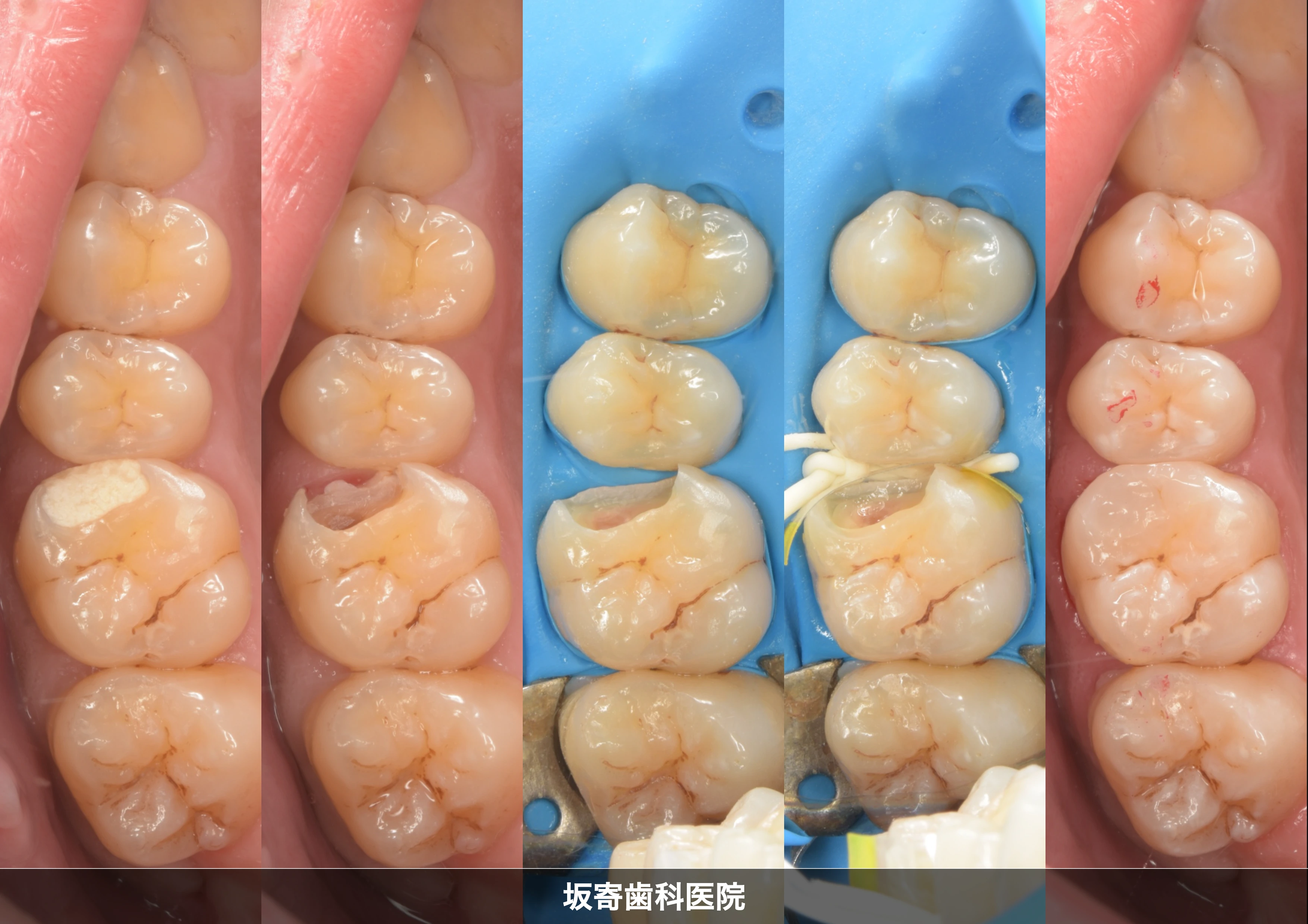 左上6番 近心咬合面 知覚過敏を伴う再治療のダイレクトボンディング修復症例(術前・仮封除去・ラバーダム防湿・マトリックス装着・研磨後)の写真コラージュ|坂寄歯科医院
