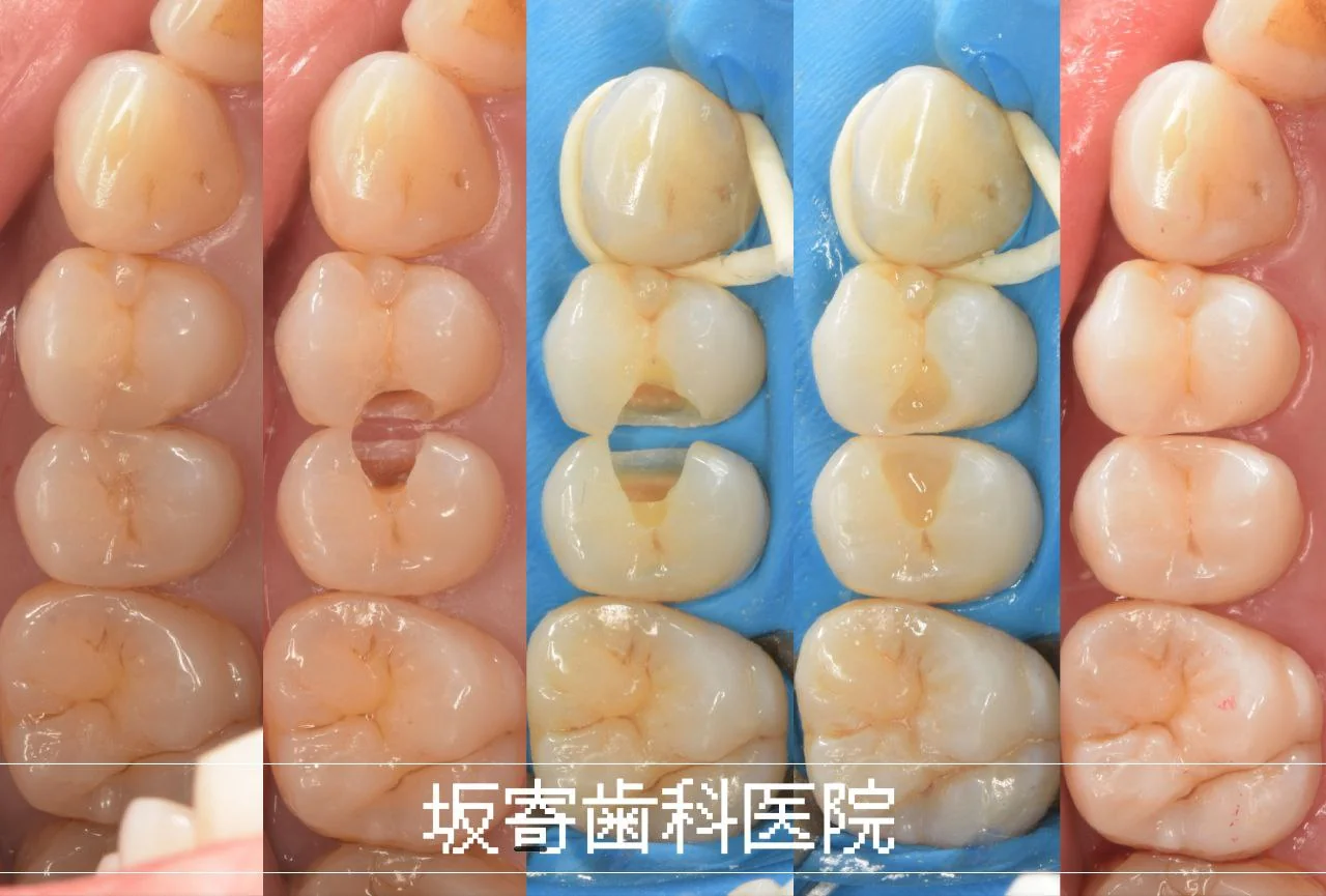 歯をできるだけ削らず再発リスクを抑える奥歯のむし歯再治療｜ダイレクトボンディング症例（上顎小臼歯・30代女性・歯科衛生士）