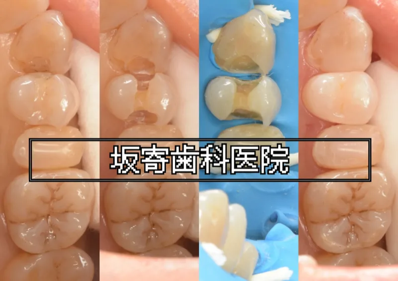 繰り返す二次むし歯を最小限の削合で再修復