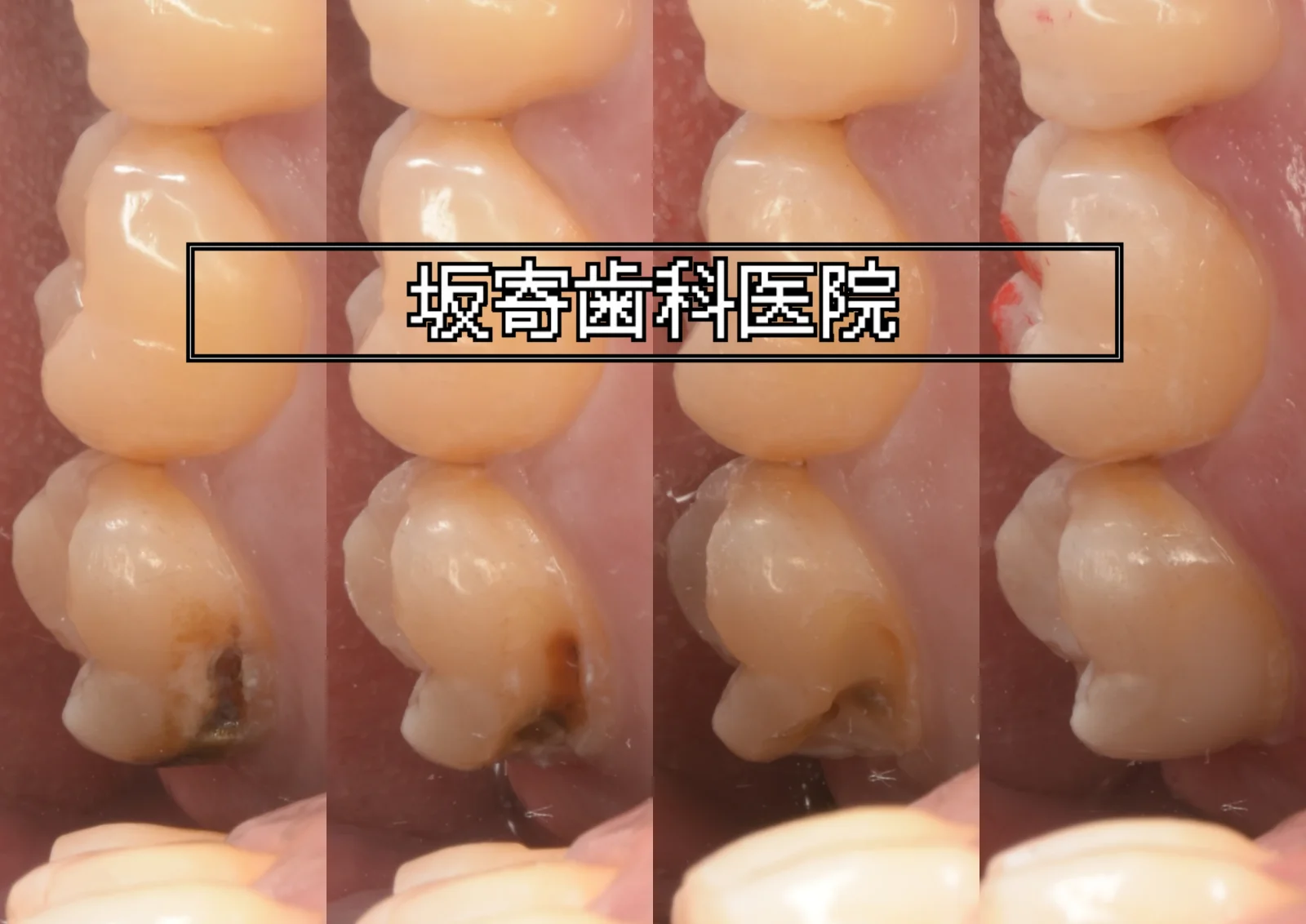 右上7番(上顎右第二大臼歯)頬側遠心のむし歯をダイレクトボンディングで修復した症例(術前・う蝕除去途中・窩洞形成後・術後)の口腔内写真コラージュ|坂寄歯科医院