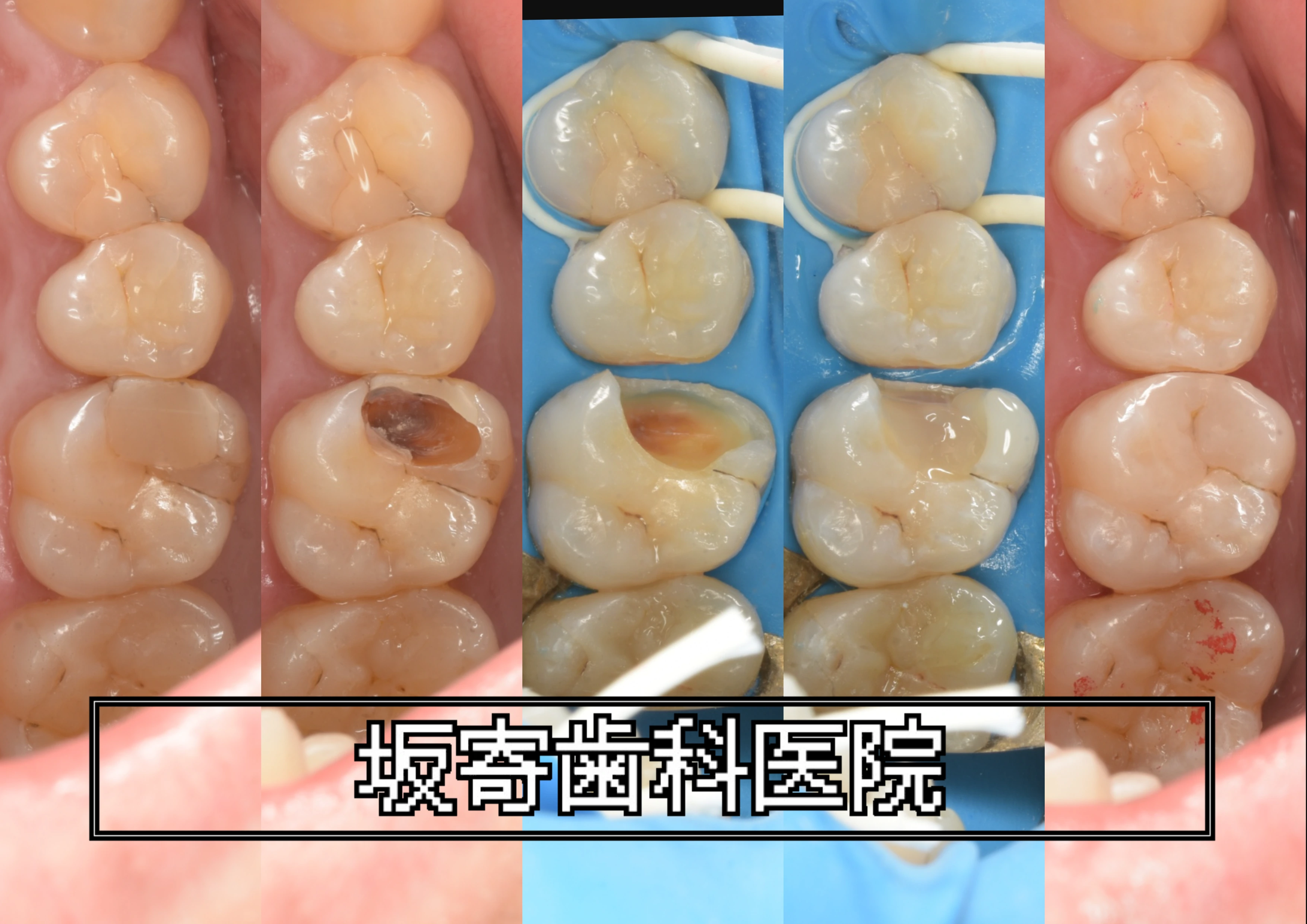 深いむし歯とクラックのある奥歯を精密に修復