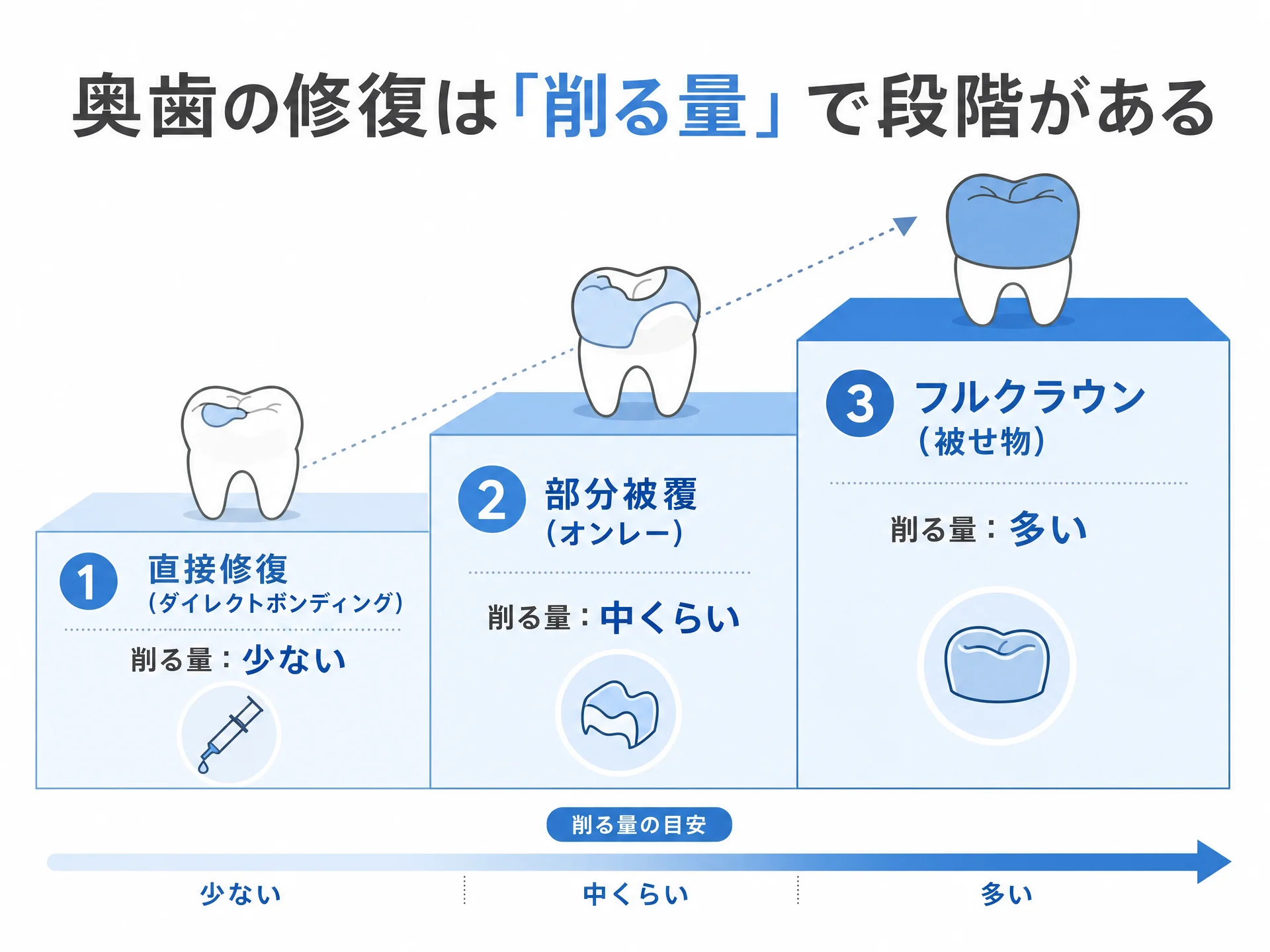 奥歯の修復方法を「削る量」で階段状に並べたインフォグラフィック。左から順に、直接修復（ダイレクトボンディング＝削る量が少ない）、部分被覆（オンレー＝中間）、フルクラウン（全体を覆う＝削る量が多い）を段階的に示した図｜取手市藤代の坂寄歯科医院