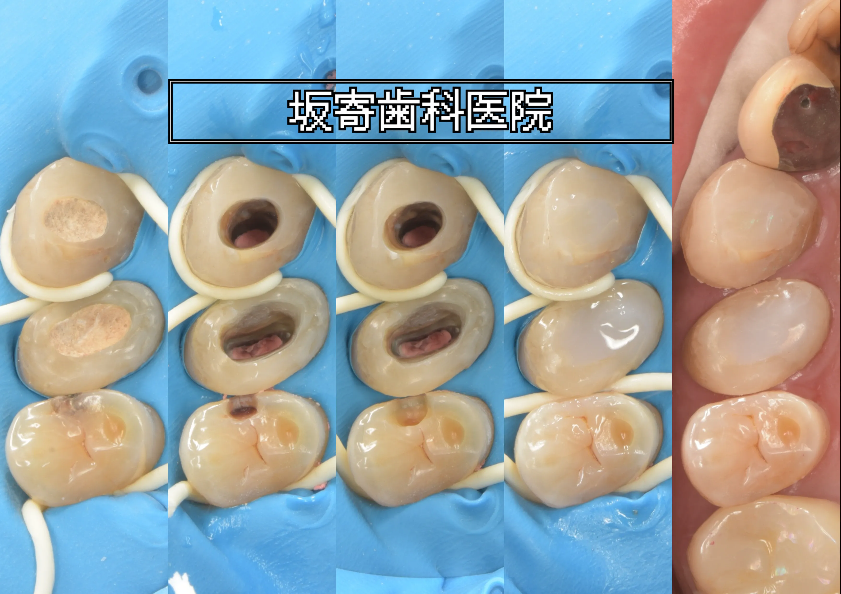 左上5番近心ダイレクトボンディングの処置5工程コラージュ写真。左から順に、ラバーダム防湿装着後／う蝕の明示／う蝕除去後の窩洞／コンポジットレジン充填直後／研磨終了後の最終仕上げ。同日に左上3・4番のレジン築造も同じラバーダム防湿下で実施｜坂寄歯科医院（取手市藤代）
