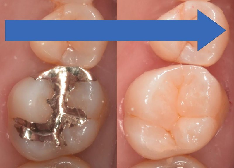 奥歯（臼歯）の銀歯をダイレクトボンディングで修復した症例①
