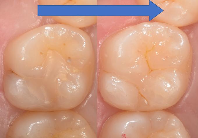 臼歯のダイレクトボンディング症例③：左が術前・右が術後のビフォーアフター